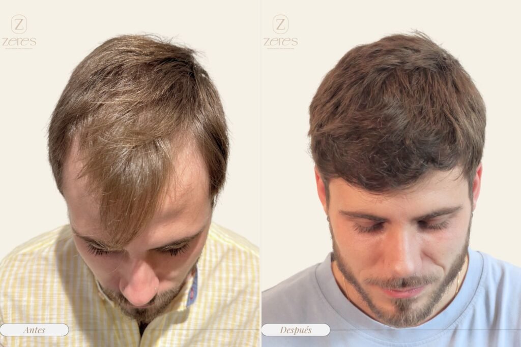 injerto capilar antes y después