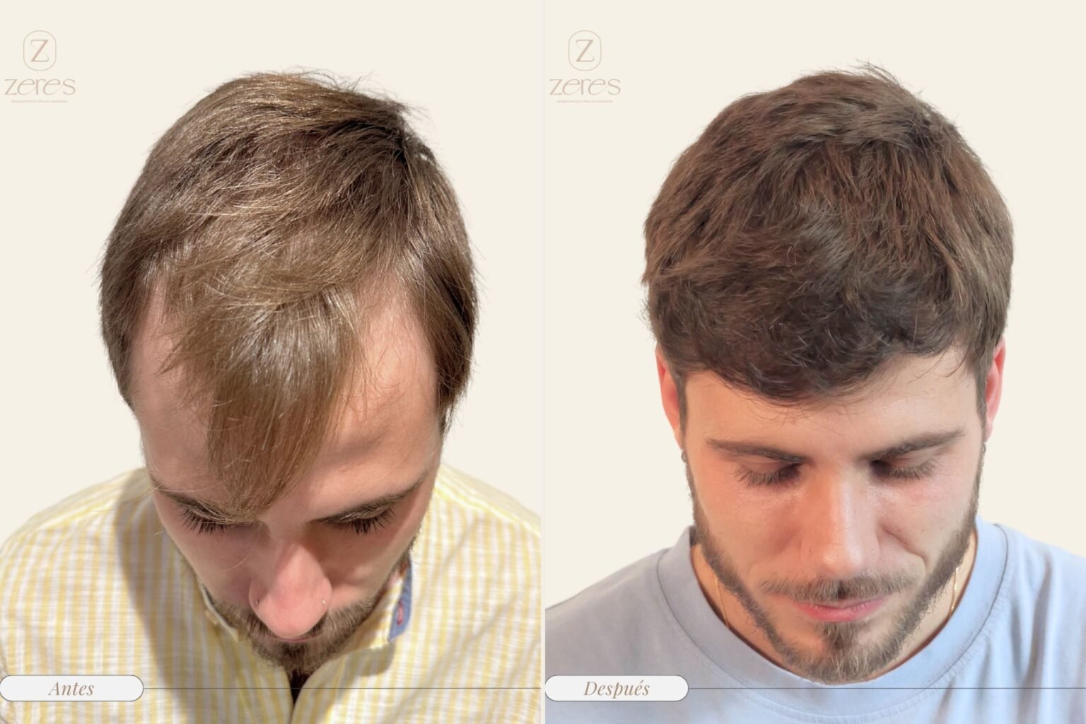 injerto capilar antes y después