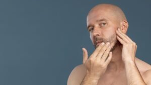 alopecia areata en la barba