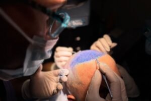 Injerto capilar cuanto dura