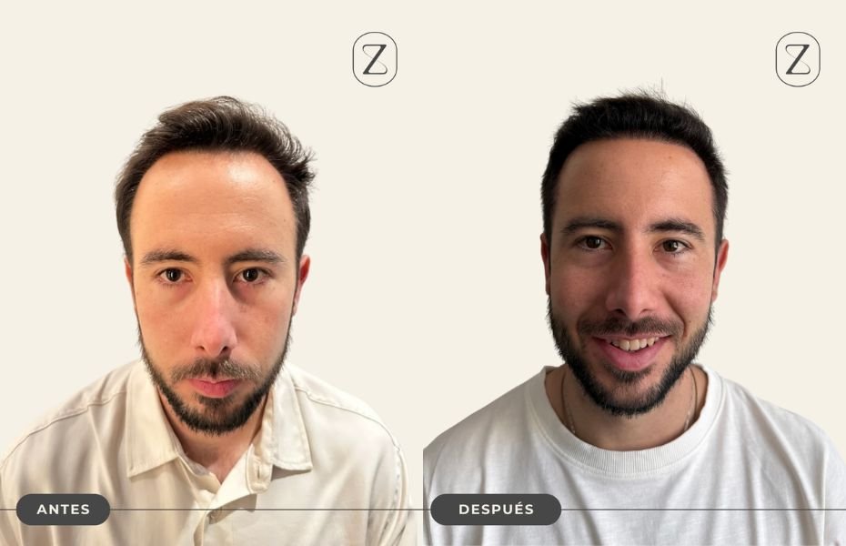 Resultado injerto capilar Javier Velis