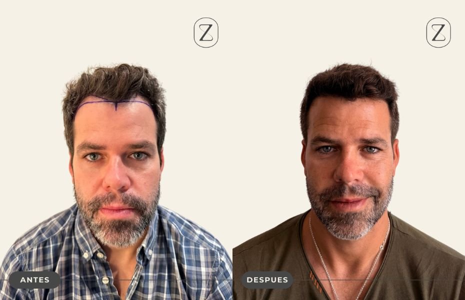 Nacho Veiga injerto capilar