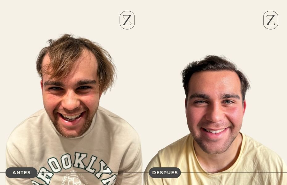 Resultado injerto capilar Rafael Fali