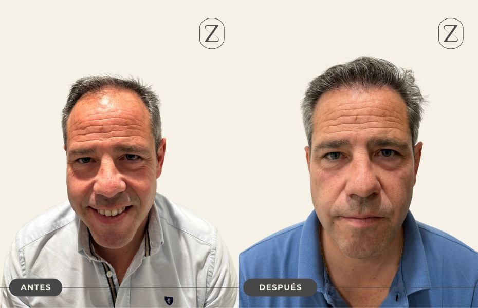 Resultado injerto capilar Raul Mostaza