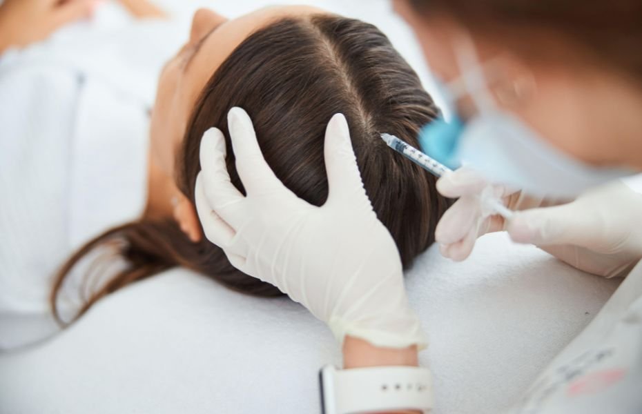 Mesoterapia Capilar