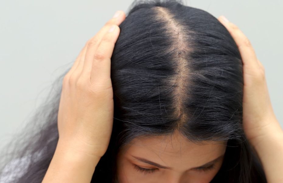 Alopecia Androgénica Femenina