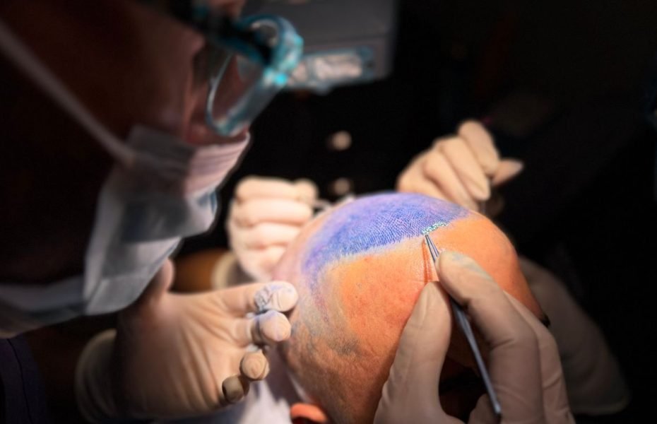 Implantación de folículos